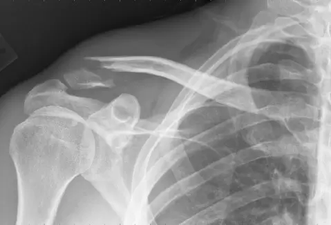 broken shoulder